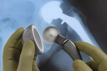 best hospital for hip replacement in purnia bihar